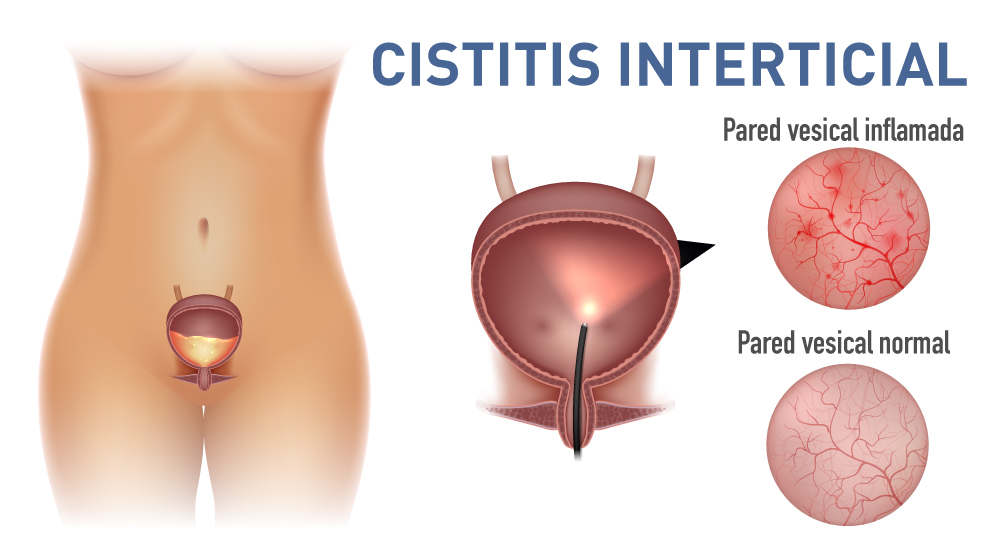 Cistitis interticial