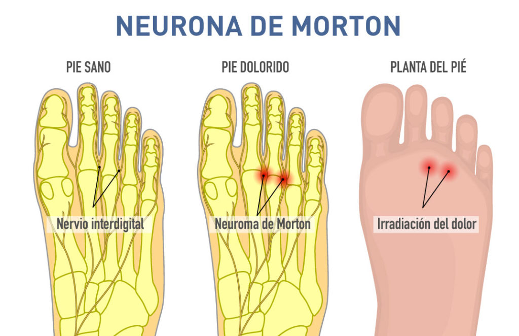 Neurona de Morton
