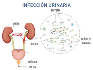 Infección urinaria