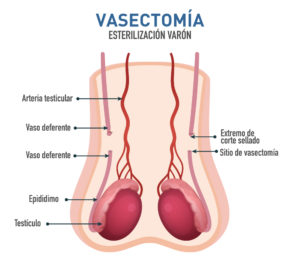 Vasectomía