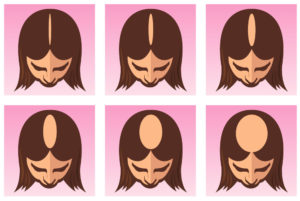 Alopecia feminoide